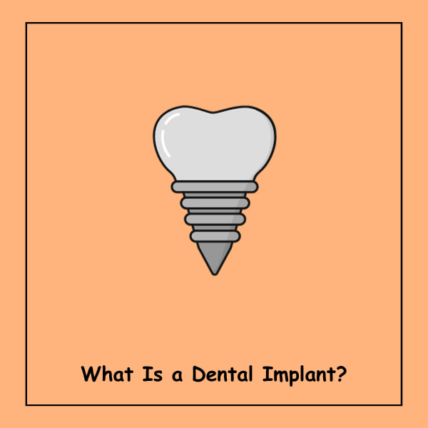 What Is a Dental Implant?